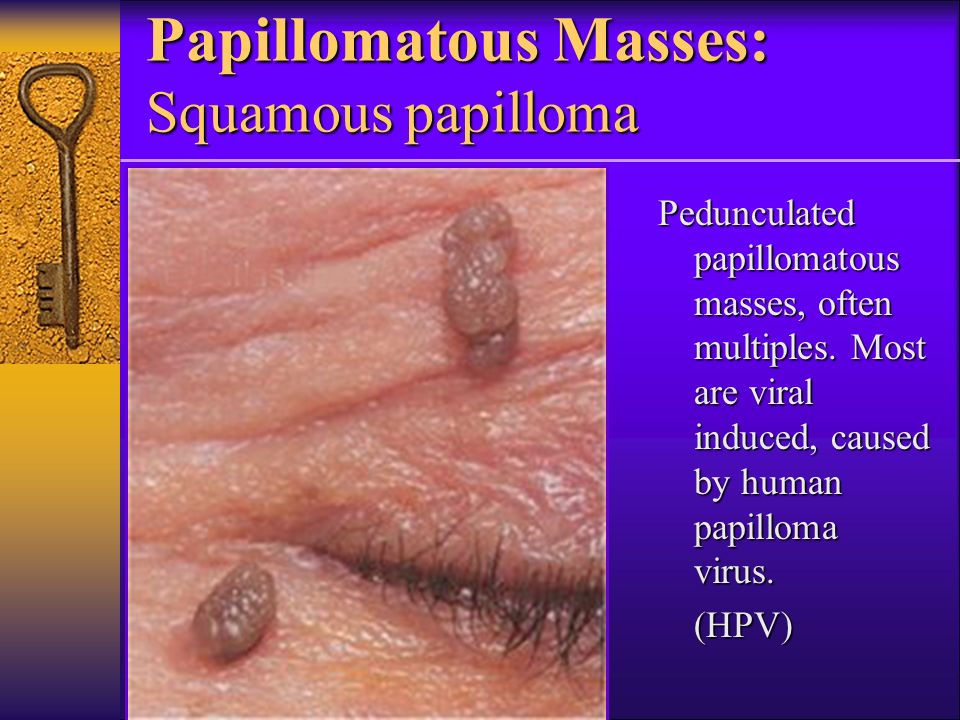 Benign papillomatous lesion, Benign squamous papilloma lesion