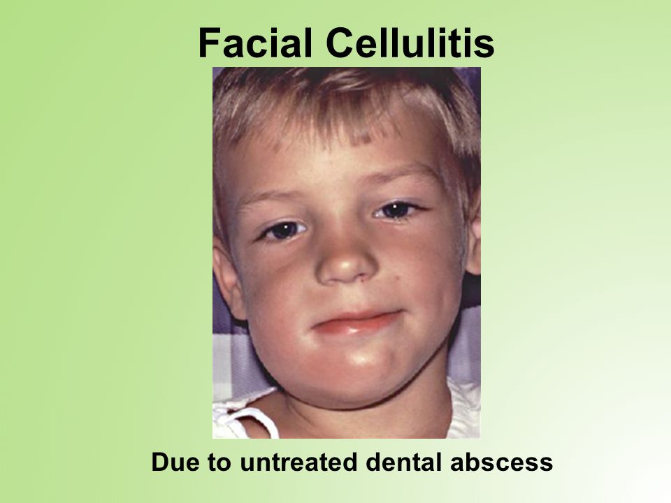 Facial Cellulitis Due to untreated dental abscess