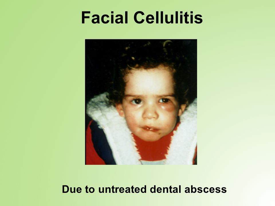Facial Cellulitis Due to untreated dental abscess