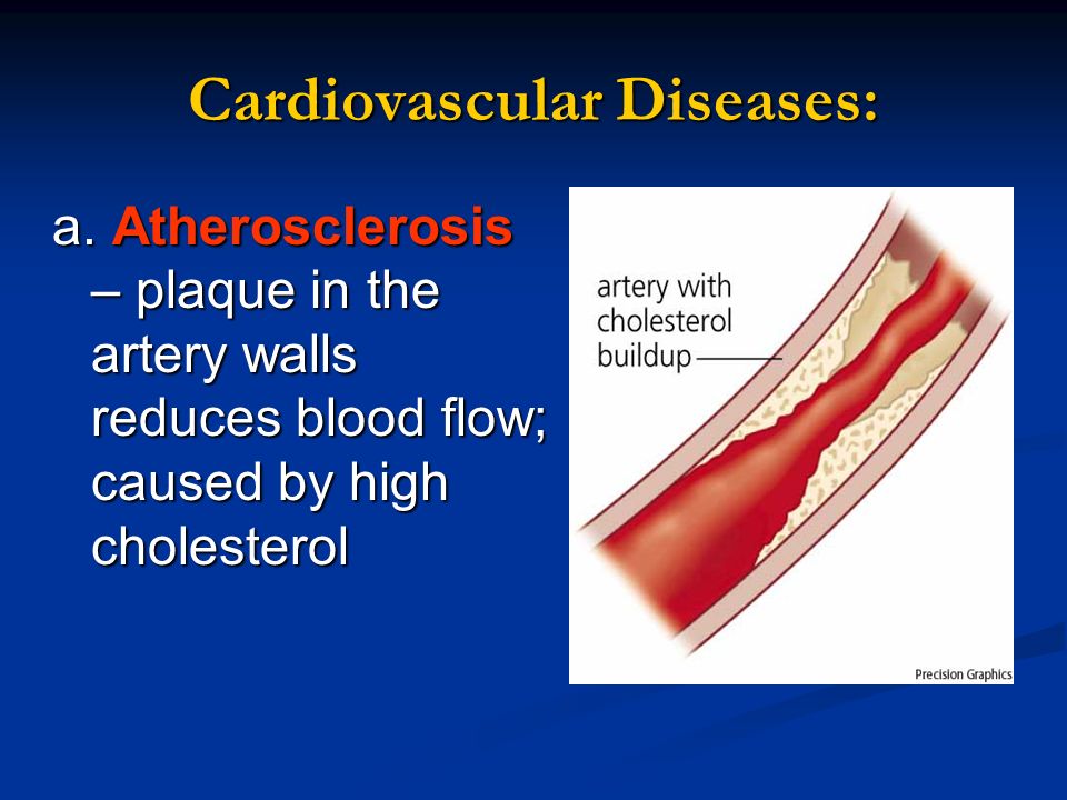 Cardiovascular Diseases: a.