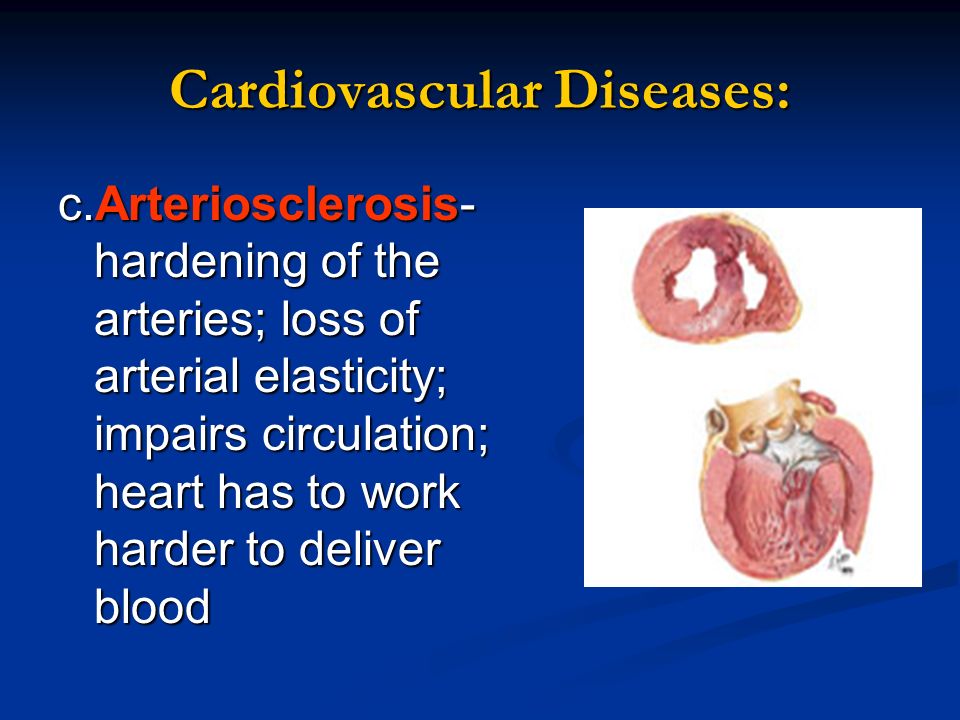 Cardiovascular Diseases: c.Arteriosclerosis- hardening of the arteries; loss of arterial elasticity; impairs circulation; heart has to work harder to deliver blood