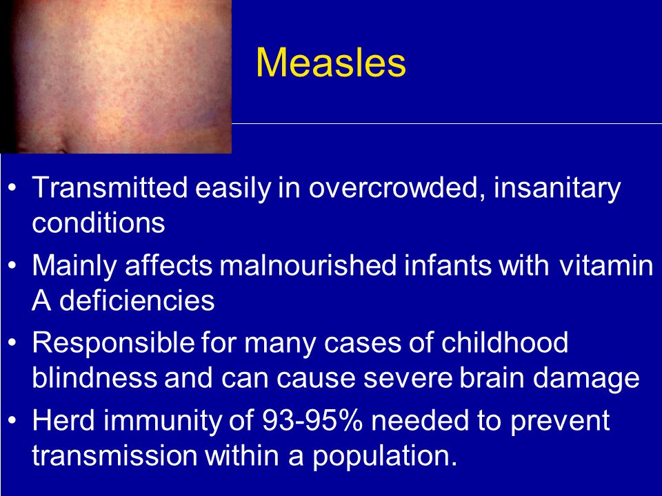 Measles Transmitted easily in overcrowded, insanitary conditions Mainly affects malnourished infants with vitamin A deficiencies Responsible for many cases of childhood blindness and can cause severe brain damage Herd immunity of 93-95% needed to prevent transmission within a population.