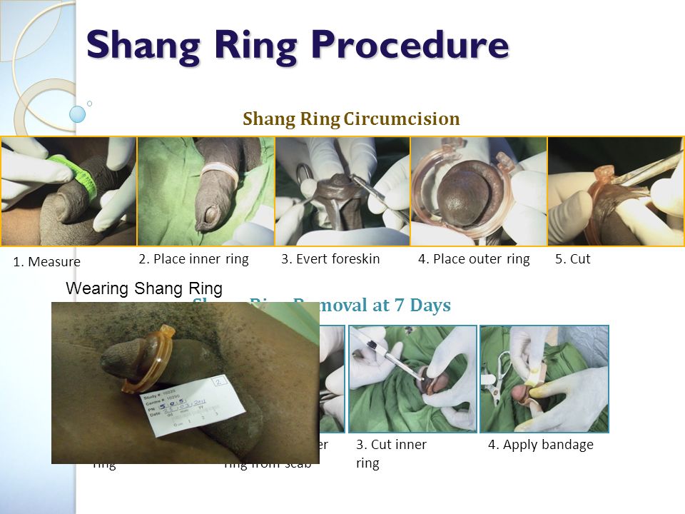 Shang Ring Procedure Shang Ring Circumcision 1. Measure 2. 