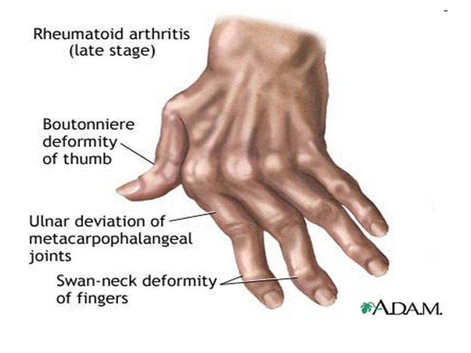 hogyan lehet kezelni a rheumatoid arthritis és a polyarthritis)