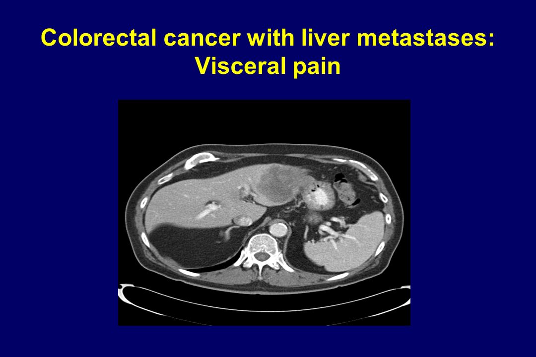 Colorectal cancer with liver metastases: Visceral pain
