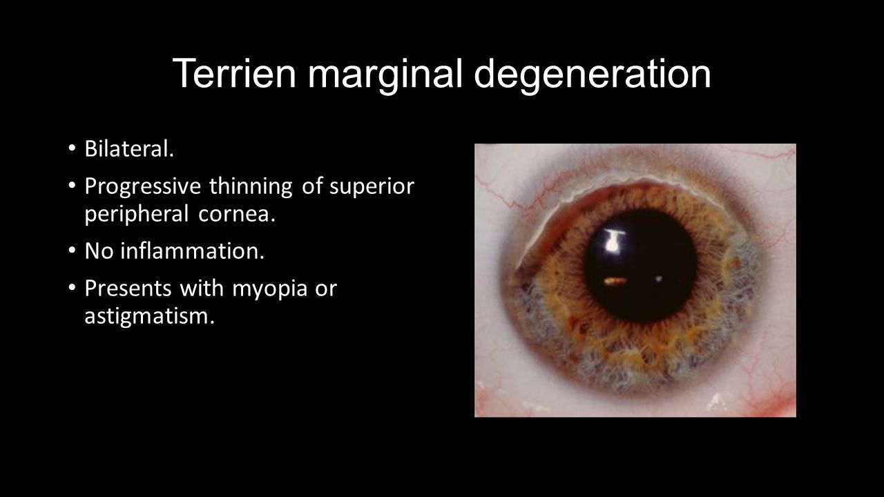 marginal corneal degeneration