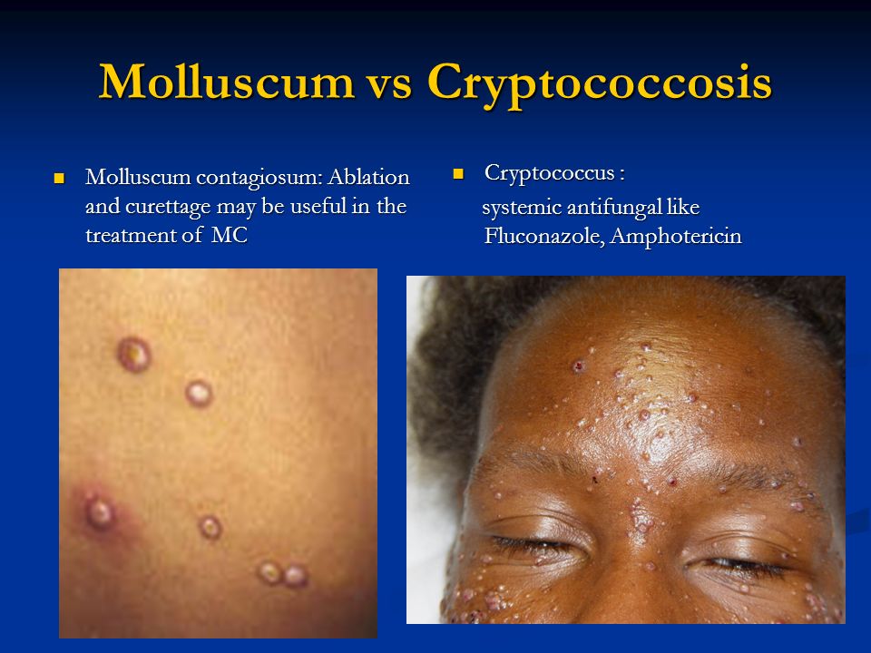 condyloma acuminatum vs molluscum contagiosum