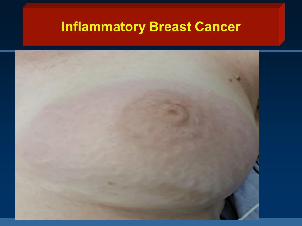 desi-picture-of-inflammatory-breast-cancer