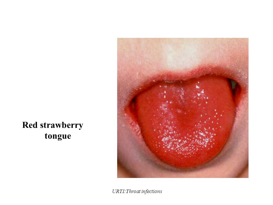 URTI:Throat infections Red strawberry tongue