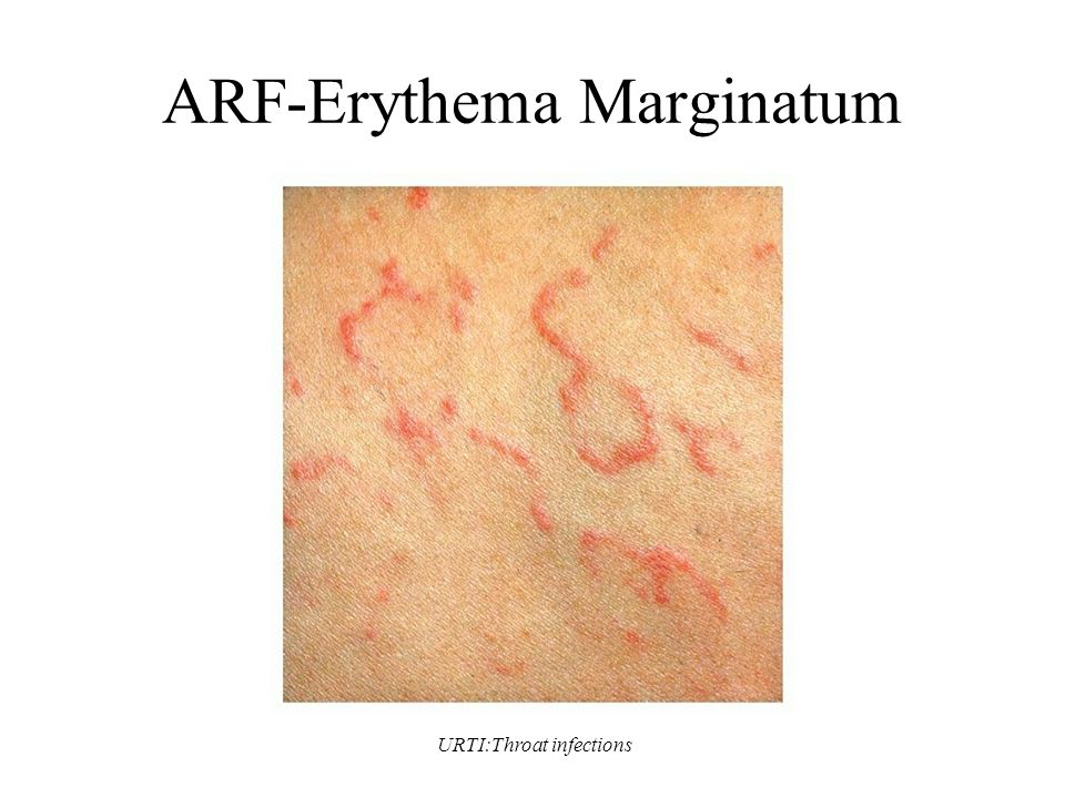 URTI:Throat infections ARF-Erythema Marginatum