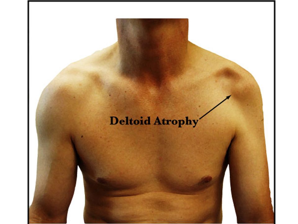 Атрофия латынь. Атрофия дельтовидной мышцы плеча. Атрофия межкостных мышц. Симптомы атрофии мышц плеча.