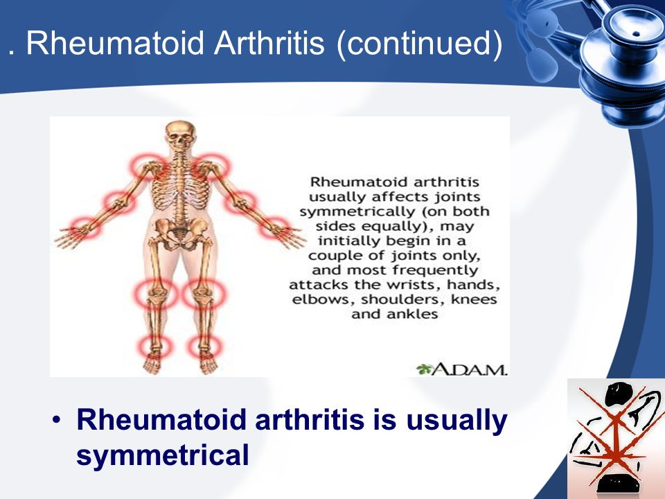 . Rheumatoid Arthritis (continued) Rheumatoid arthritis is usually symmetrical
