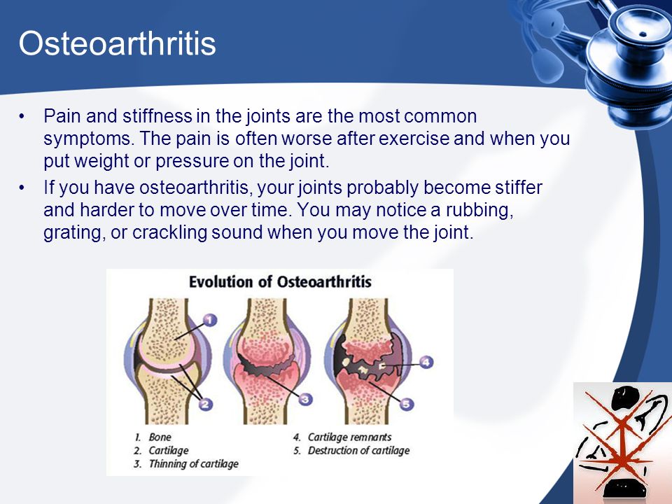Osteoarthritis Pain and stiffness in the joints are the most common symptoms.