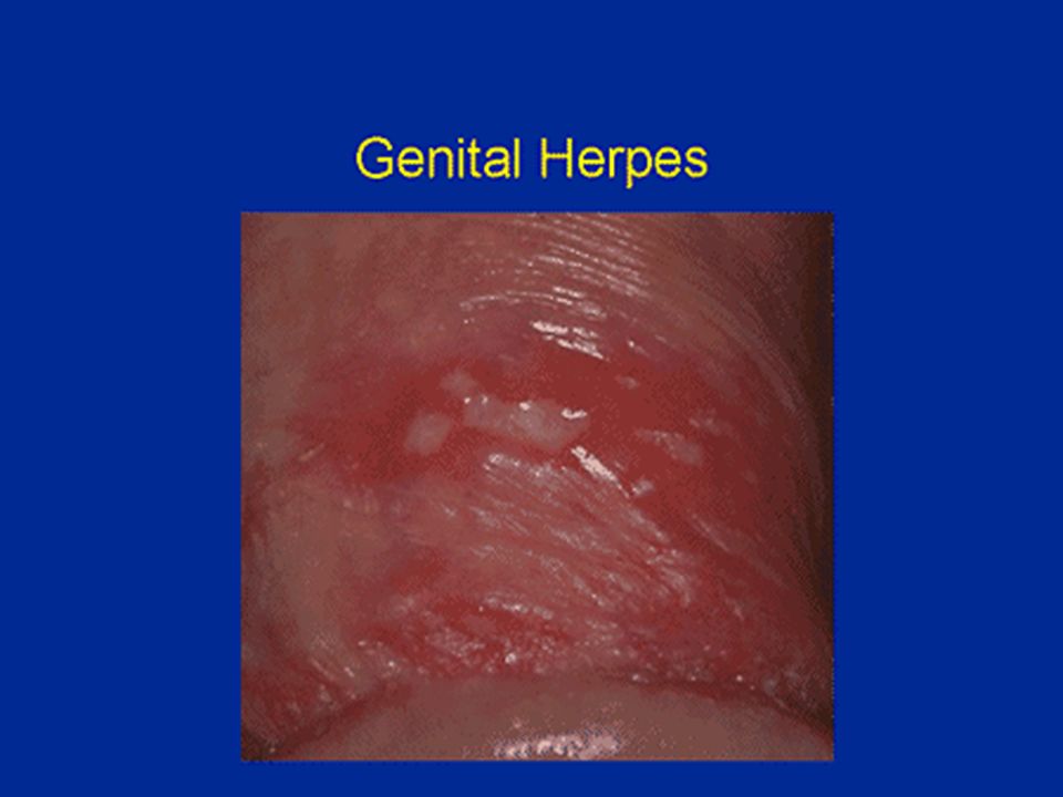 Herpes i underlivet - 🧡 Hsv 1 Pictures Female - Maverick Farrow.