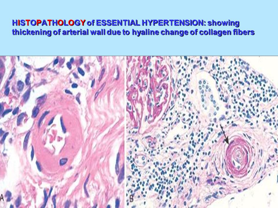 HISTOPATHOLOGY of ESSENTIAL HYPERTENSION: showing thickening of arterial wall due to hyaline change of collagen fibers