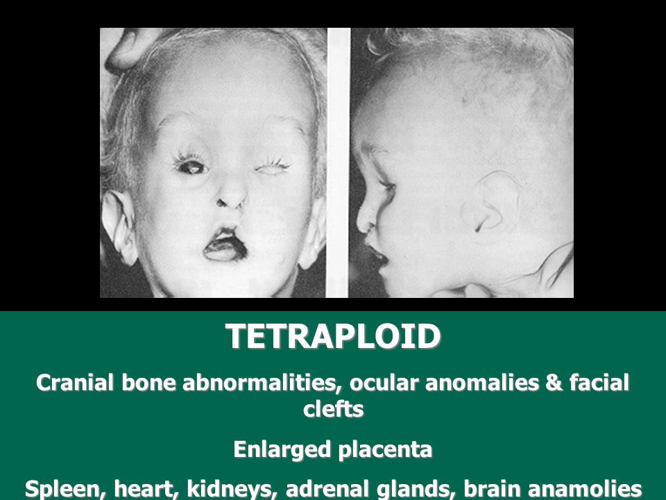 GENETIC DISORDERS SBI3U HEREDITARY DISORDERS (nature) - genetic  abnormalities caused by recombination aneuploidy, sex-linked,  nondisjunction CONGENITAL. - ppt download