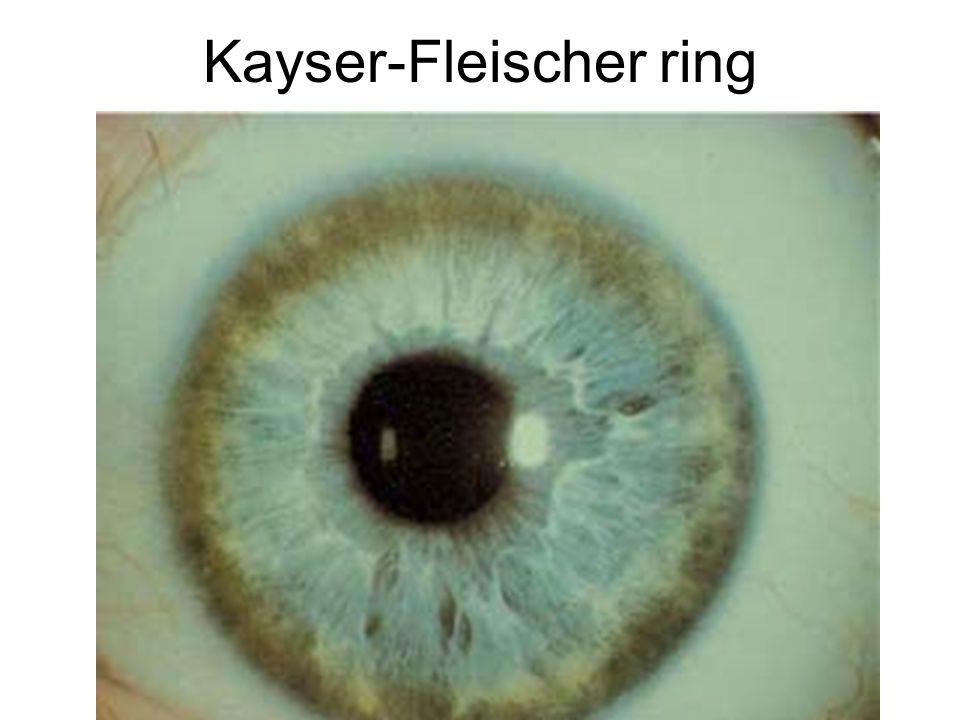 Кольца кайзера флейшера на карих глазах