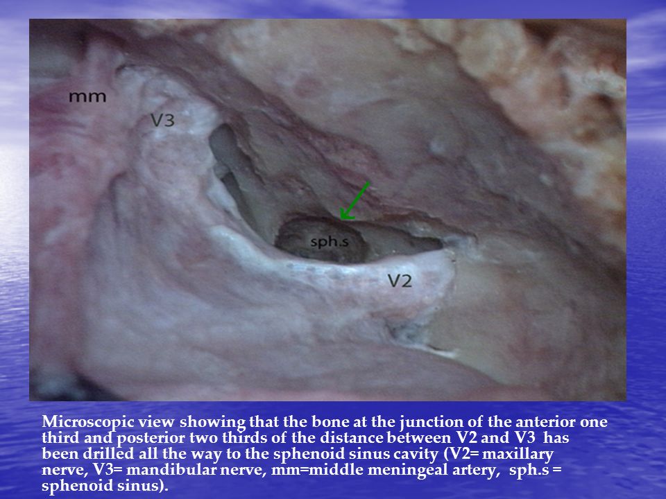 Microscopic view showing that the bone at the junction of the anterior one third and posterior two thirds of the distance between V2 and V3 has been drilled all the way to the sphenoid sinus cavity (V2= maxillary nerve, V3= mandibular nerve, mm=middle meningeal artery, sph.s = sphenoid sinus).