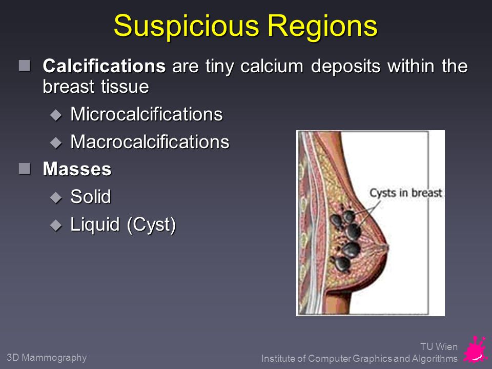calcium deposits on the breast Calcium deposits on the breast