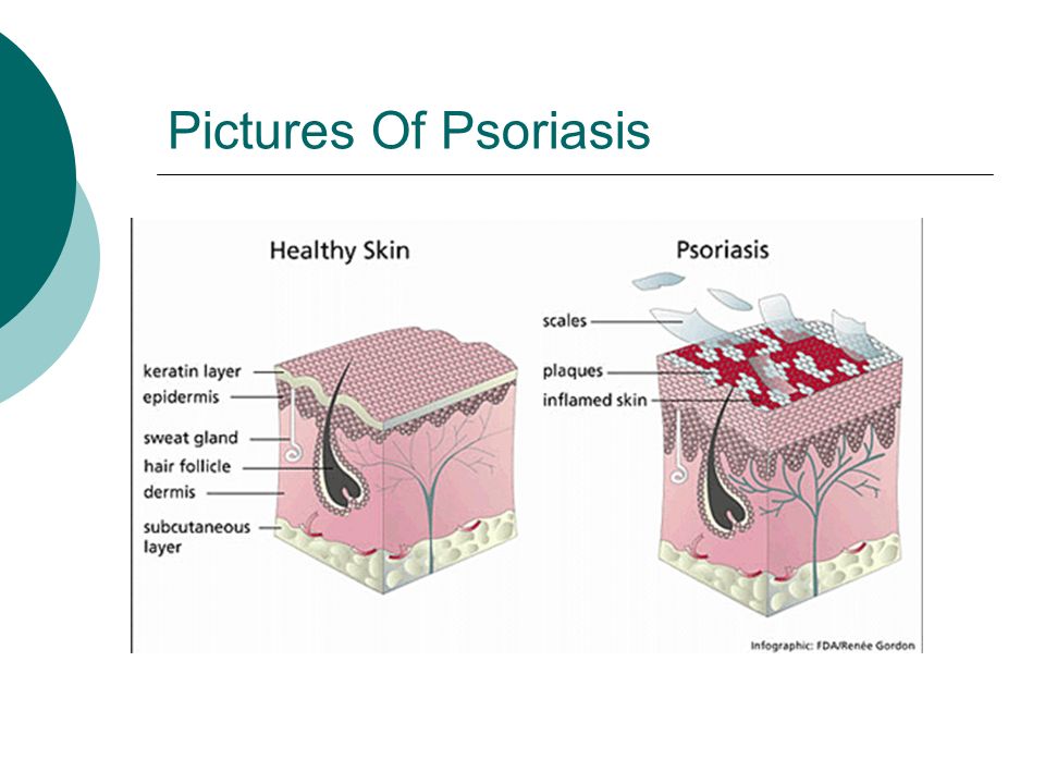 Pictures Of Psoriasis