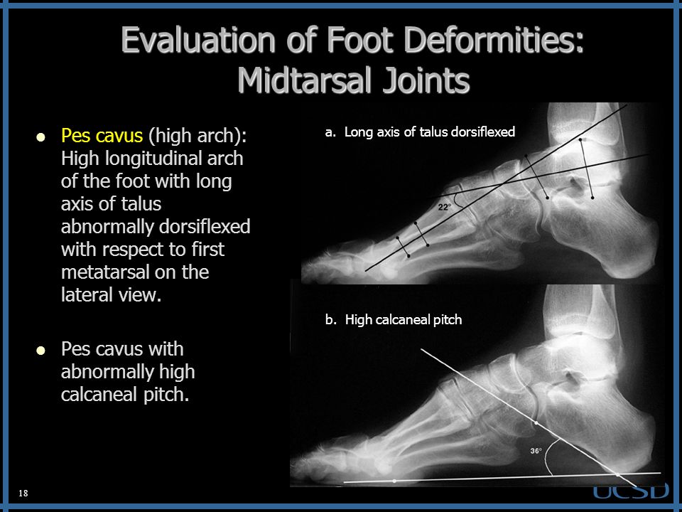 1 Radiographic Evaluation of the Pediatric Foot and its Deformities Amy C.  Wu, MD UCSD Department of Radiology. - ppt download