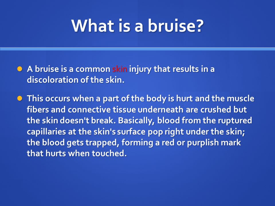 What is a bruise. A bruise is a common skin injury that results in a discoloration of the skin.