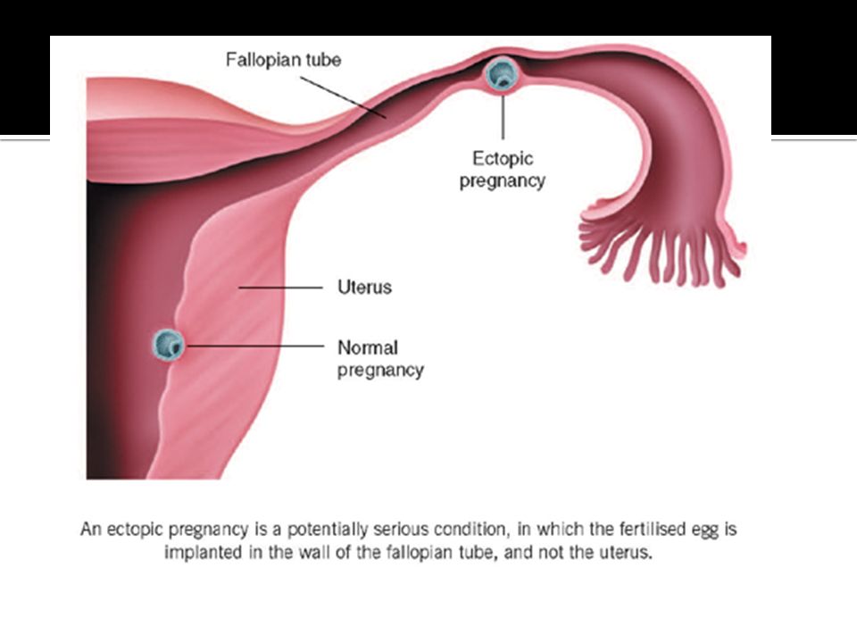 Polipo en el utero embarazo