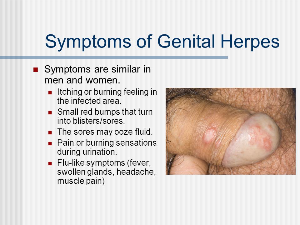 Genital herpes on penis you uneasy Necessary phrase... Genital herpes on penis are not