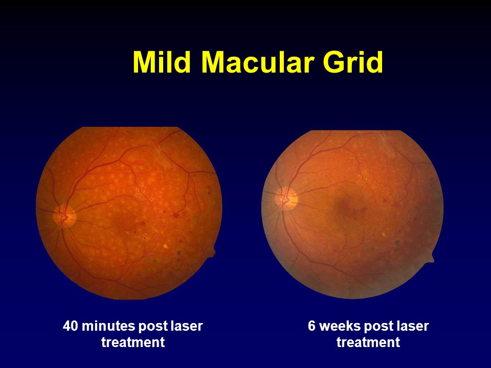 Comparison of Modified ETDRS and Mild Macular Grid Laser Photocoagulation  Strategies for Diabetic Macular Edema Sponsored by the National Eye  Institute, - ppt download