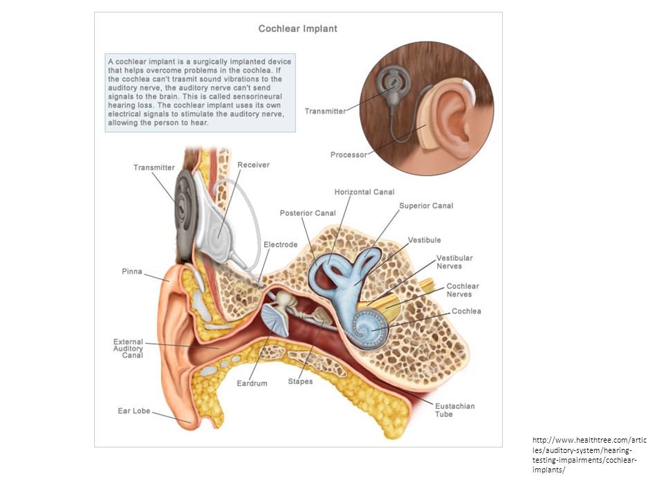 Hear system. Аппарат Cochlear кохлеарный Cochlear. Кохлеарный имплант кохлеар. Vestibular-Cochlear nerve.