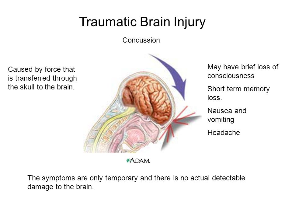 After brain. Post traumatic Syndrome Symptoms. Have a concussion. Concussion Symptoms. Concussion Ram Palanite.