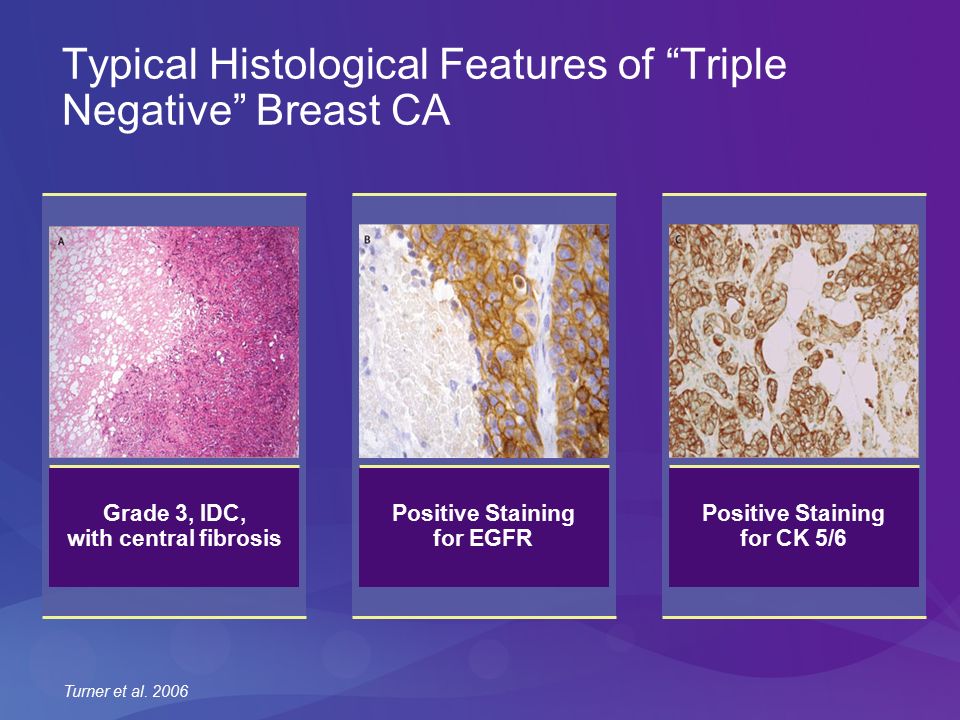 Epidemiology Definition Biology Basal Like The Triple Negative Breast Cancer Estrogen Receptor Er Negative Progesterone Receptor Pr Negative Ppt Download