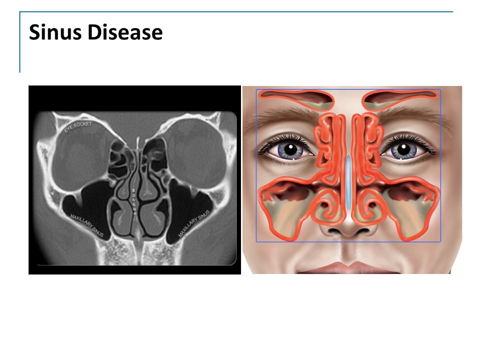 Sinus Disease