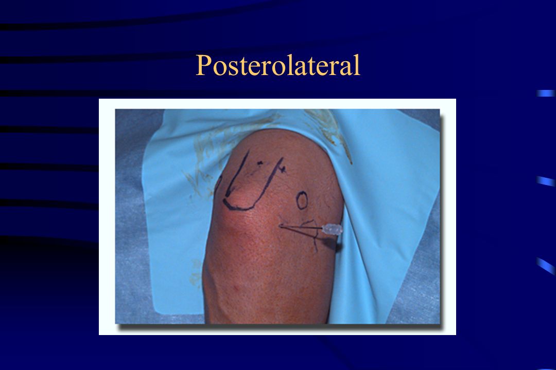 Posterolateral