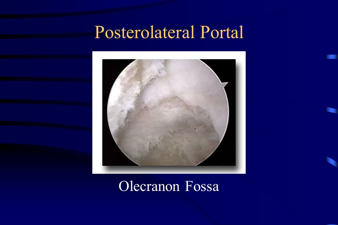 Posterolateral Portal Olecranon Fossa