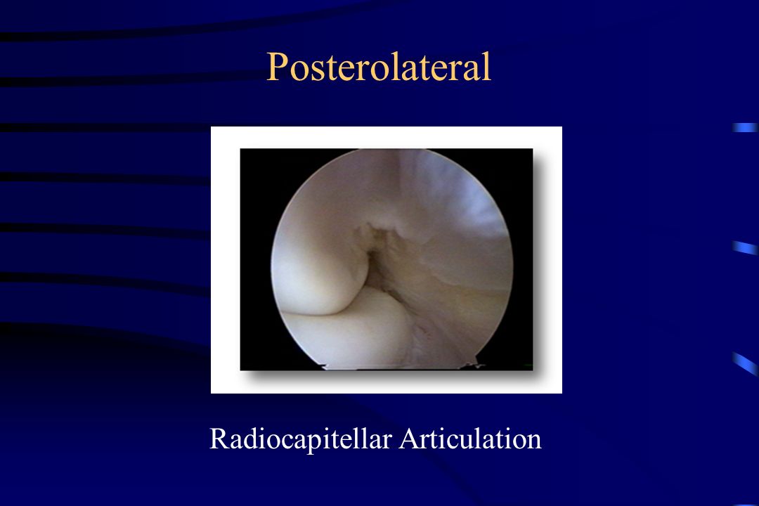 Posterolateral Radiocapitellar Articulation
