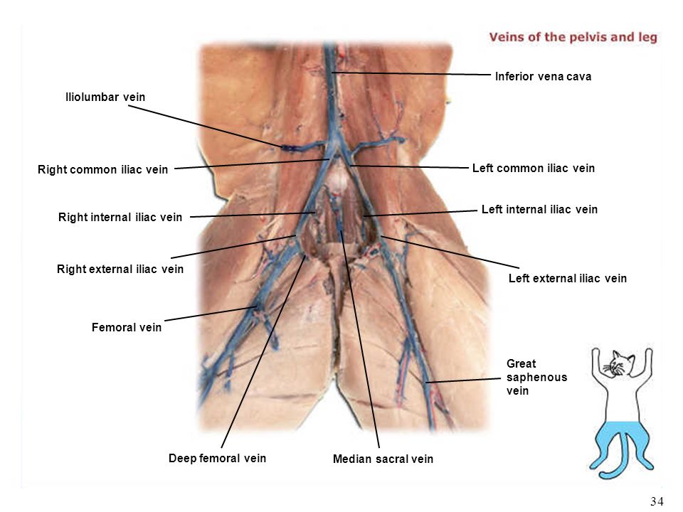 34 Great saphenous vein Left external iliac vein Left internal iliac vein Left common iliac vein Inferior vena cava Iliolumbar vein Right common iliac vein Right internal iliac vein Right external iliac vein Femoral vein Deep femoral vein Median sacral vein