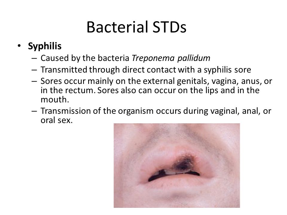 Sexually transmitted disease from oral sex