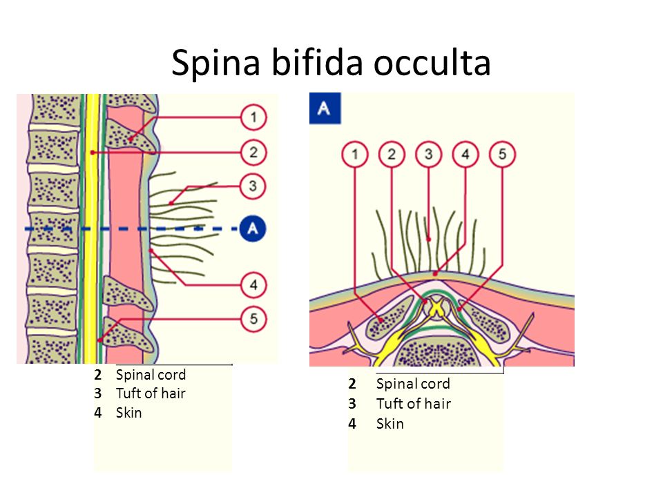 spina bifida occulta hair