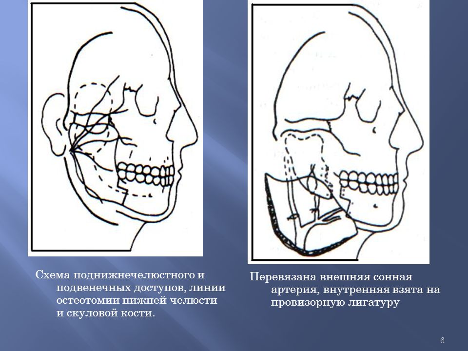 Развитие лицевой области. Челюстно лицевая хирургия перелом скуловой кости. Репозиция скуловой кости. Переломы скуловой кости и дуги схемы. Комбинированная травма челюстно лицевой области.