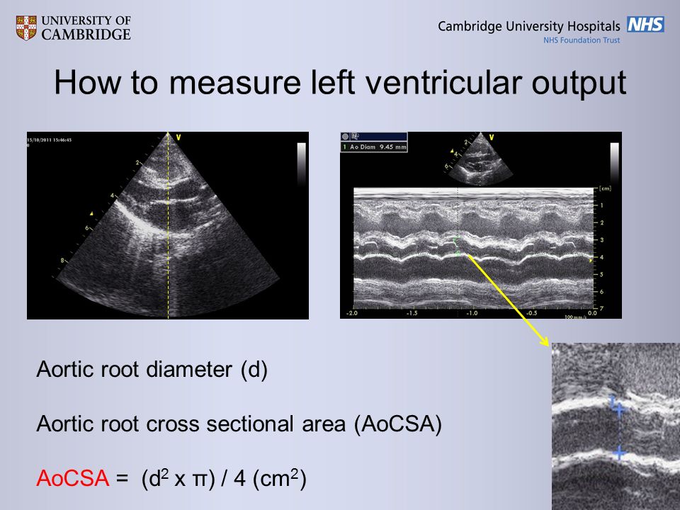 How to measure left ventricular output Aortic root diameter (d) Aortic root cross sectional area (AoCSA) AoCSA = (d 2 x π) / 4 (cm 2 )