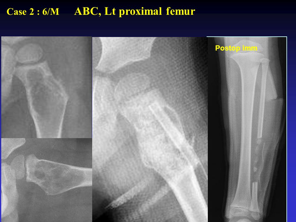 Case 2 : 6/M ABC, Lt proximal femur Preop Postop imm