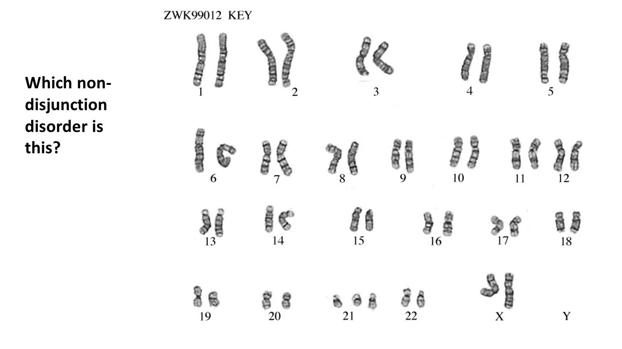 Спаривание хромосом. Синдром Дауна трисомия 21 хромосомы. Трисомия по 21 хромосоме. Синдром Дауна кариотип.