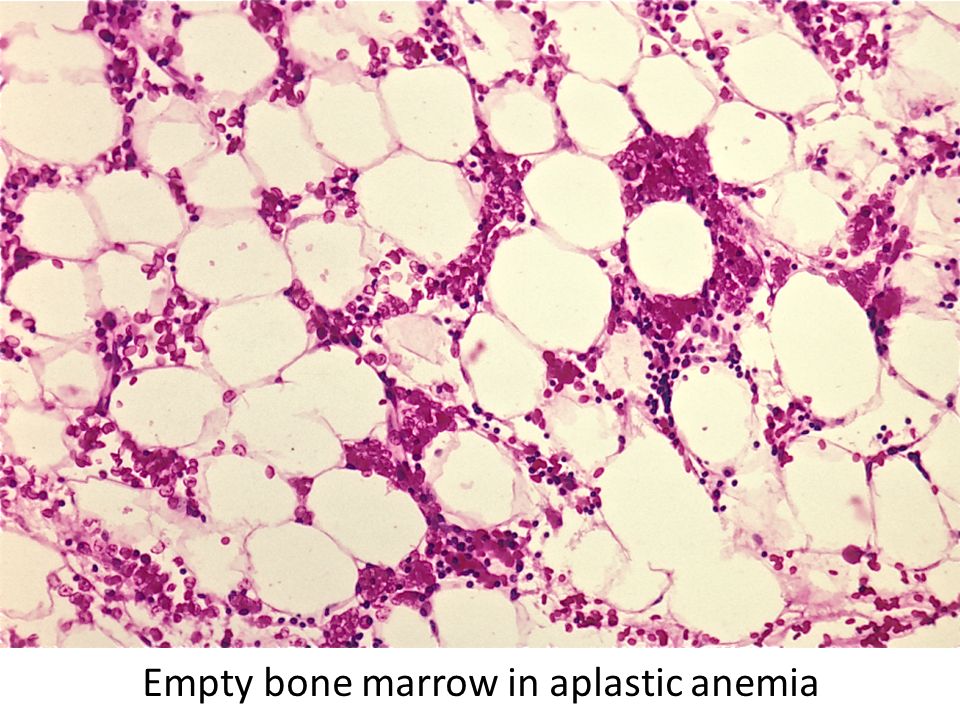 Пораженный костный мозг. Апластическая анемия микро. Апластическая анемия микропрепарат. Апластическая анемия костный мозг. Апластическая анемия гистология.