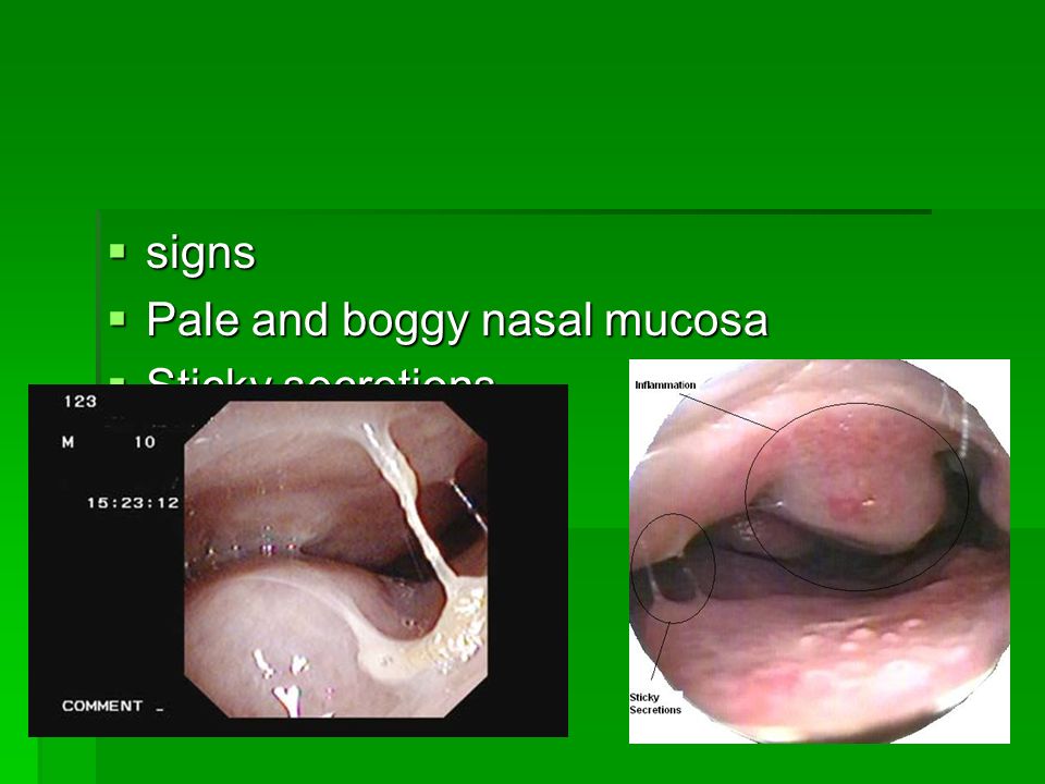Upper Respiratory Tract Diseases in Workplace. Characteristics of upper  resp. tract \uf0a7N\uf0a7N\uf0a7N\uf0a7Nares to larynx \uf0a7T\uf0a7T\uf0a7T\uf0a7Tasks: \uf0a7A\uf0a7A\uf0a7A\uf0a7Air conditioning (T  and. - ppt download