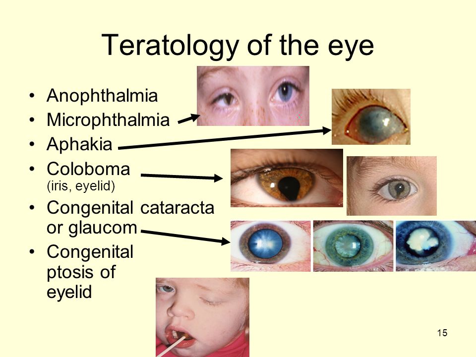 15 Teratology of the eye Anophthalmia Microphthalmia Aphakia Coloboma (iris, eyelid) Congenital cataracta or glaucom Congenital ptosis of eyelid