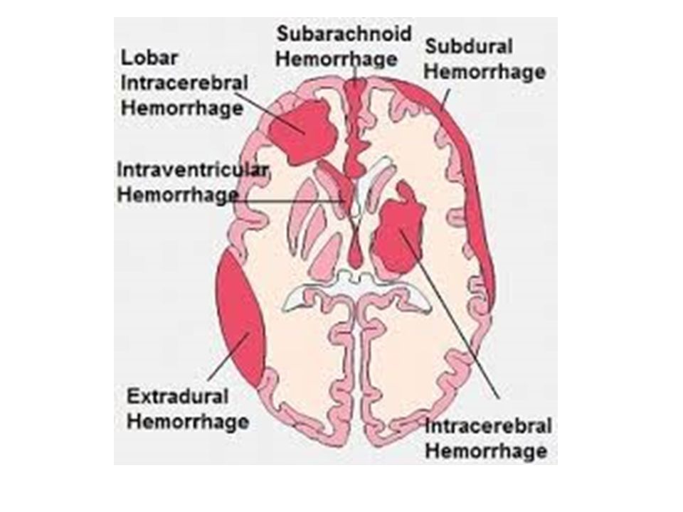 subdural hematoma vs cerebral hemorrhage subdural hematoma vs cerebral hemorrhage