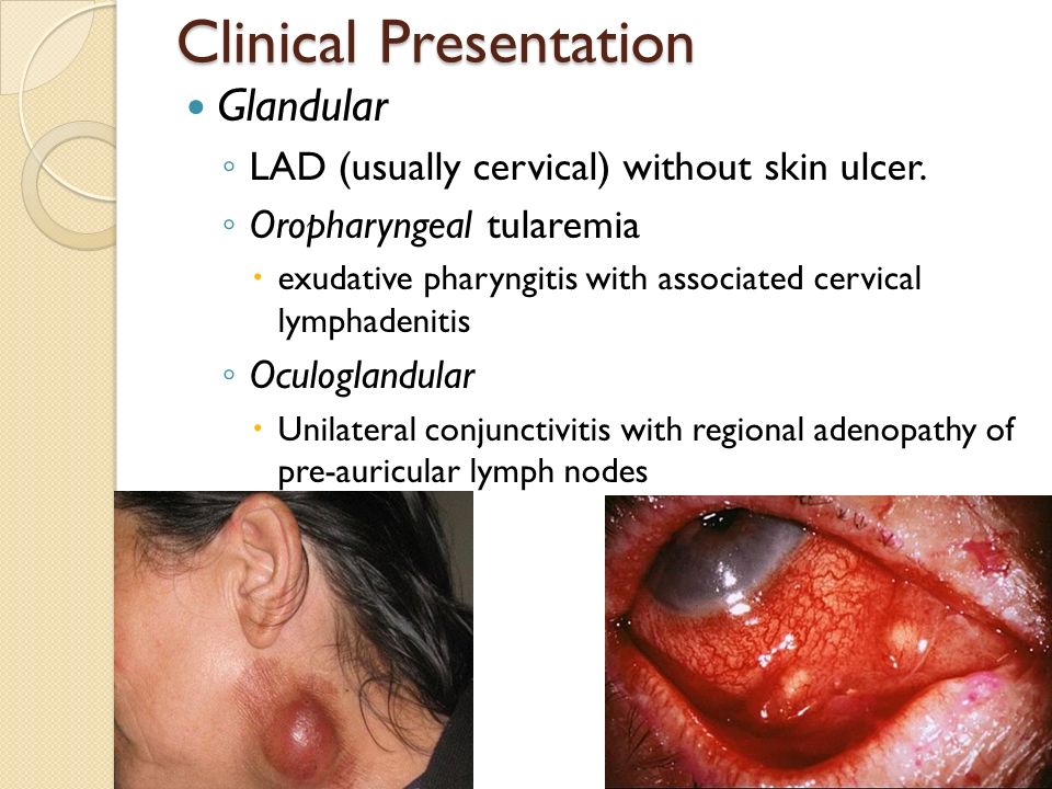 oropharyngeal tularemia