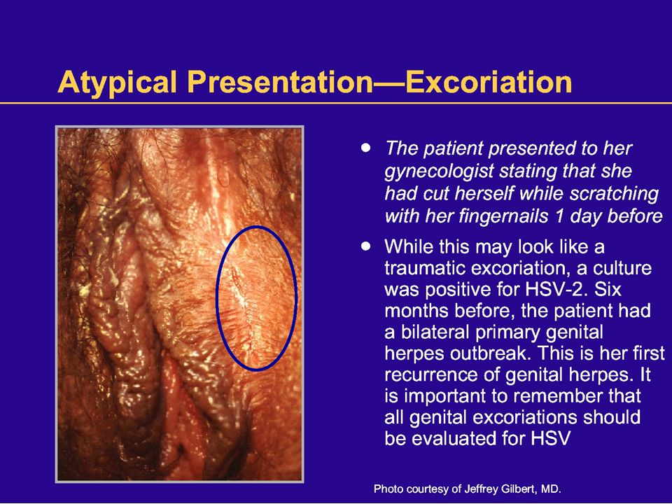 vaginal cuts herpes Vaginal cuts herpes