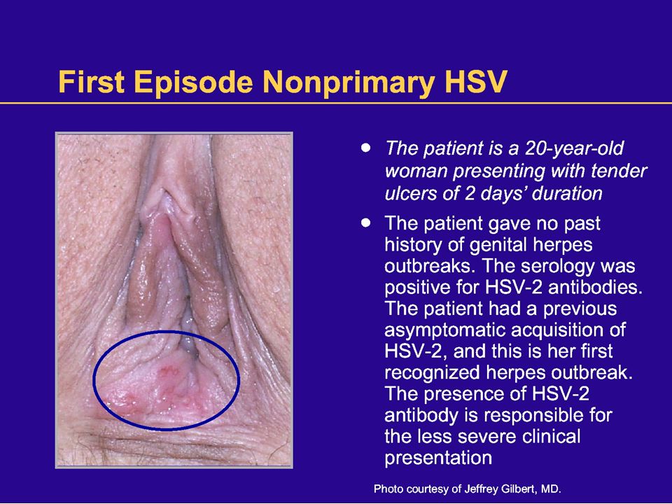 New Developments In The Management Of Genital Herpes Elaine